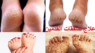 تقشير القدمين من الجلد الميت وتفتيحها من اول استخدام