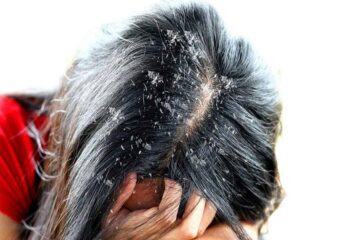تخلصي من قشرة الشعر نهائيا بمكونات طبيعيه موجوده في المنزل