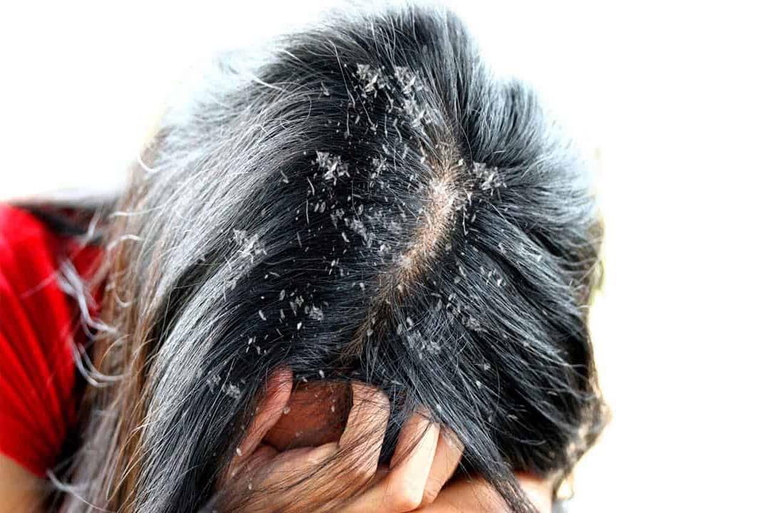 تخلصي من قشرة الشعر نهائيا بمكونات طبيعيه موجوده في المنزل 5 تخلصي من قشرة الشعر نهائيا بمكونات طبيعيه موجوده في المنزل