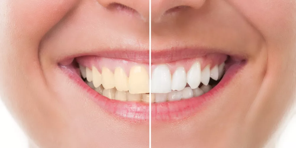 3 وصفات طبيعية جبارة..للحصول على أسنان ناصعة البياض لضحكة أكثر جمالًا