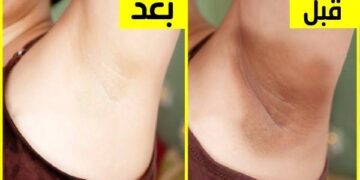  وداعاً للاحراج وارتداء الملابس المقفولة.. احصلى على التفتيح الفورى بخلطة طبيعية تفتح الابط