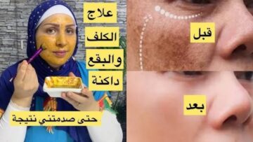 سيروم طبيعي للبشرة هيشيل كل الكلف والتصبغات في أسرع وقت