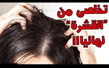 تخلصي من قشرة الشعر بطرق منزلية فعالة باستخدام الأسبرين والملح وجل الصبار
