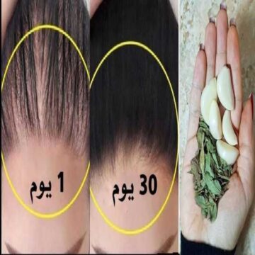 وصفة للتخلص من الصلع.. جربتها وفعلا طلع شعر صغير في مقدمة الشعر بعد شهر من استخدامها