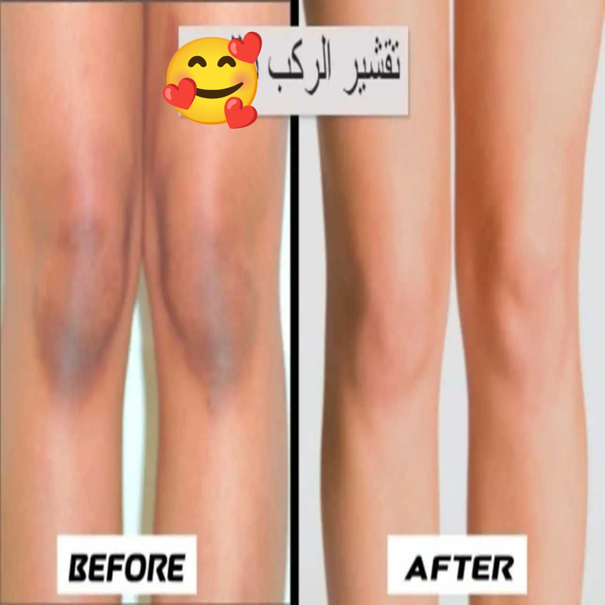 وصفة مفيدة لتقشير وتبييض الركب والأكواع بسرعة.. مش هتصدقي النتيجة 5 وصفة مفيدة لتقشير وتبييض الركب والأكواع بسرعة.. مش هتصدقي النتيجة