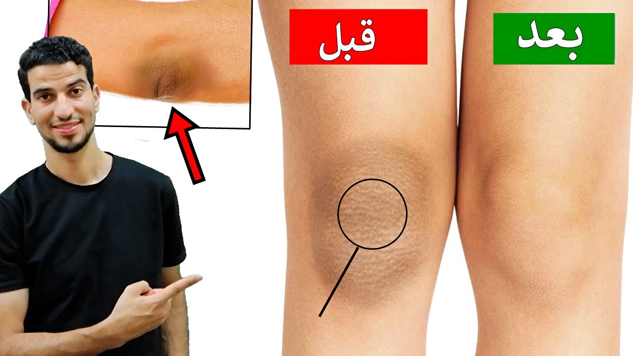اقوي وصفة لتبييض وتنعيم الكوع والكعبين من الخشونة والسواد بوصفات طبيعية أمنة 5 اقوي وصفة لتبييض وتنعيم الكوع والكعبين من الخشونة والسواد بوصفات طبيعية أمنة
