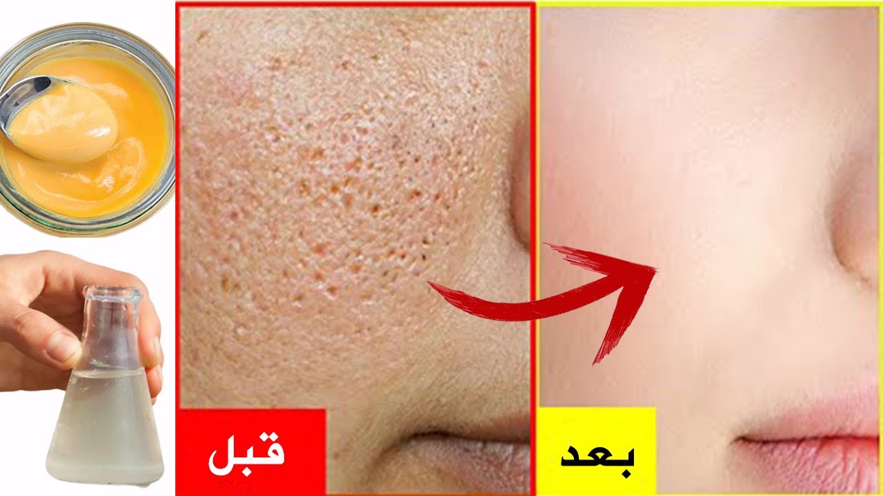 قناع ماء الورد والنشا للحصول على بشرة ناعمة وخالية من المسامات الواسعة 5 قناع ماء الورد والنشا للحصول على بشرة ناعمة وخالية من المسامات الواسعة