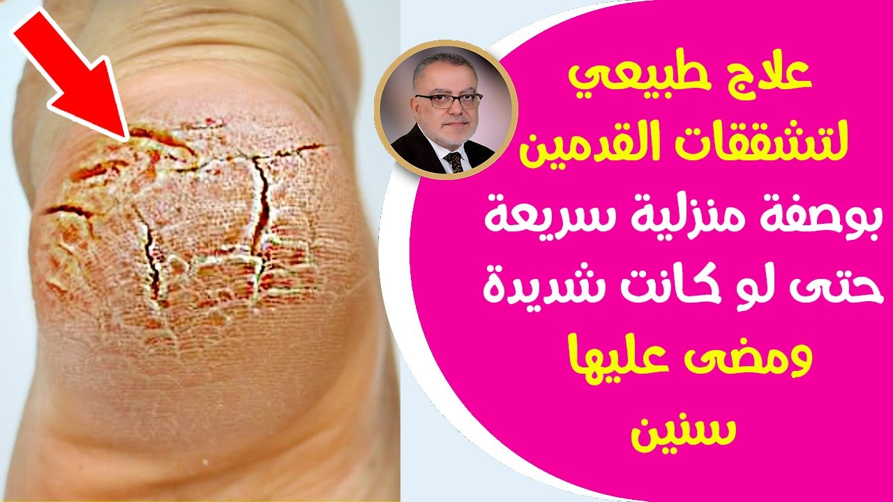 علاج تشقق القدمين نهائيًا بأفضل الوصفات المجربة 6 علاج تشقق القدمين نهائيًا بأفضل الوصفات المجربة