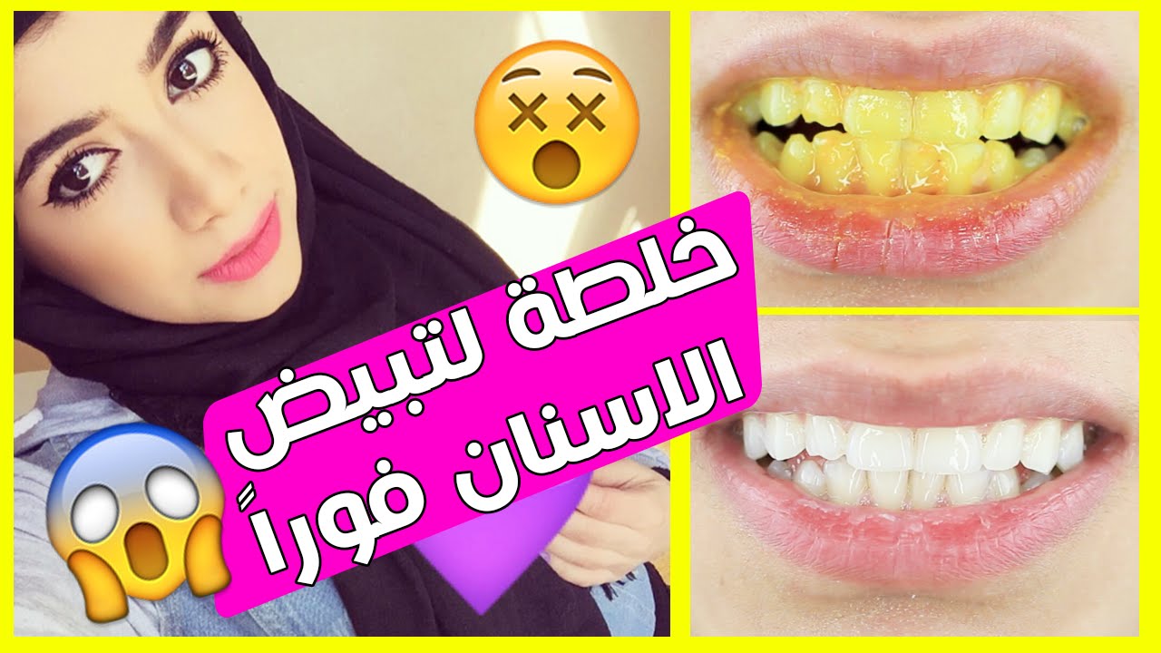تبييض الأسنان في 5 دقائق بمواد طبيعية ... أسنانك لؤلؤ من أول مرة 5 تبييض الأسنان في 5 دقائق بمواد طبيعية … أسنانك لؤلؤ من أول مرة