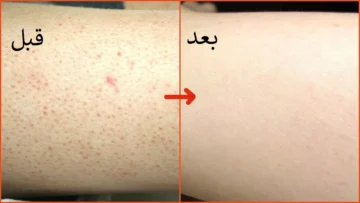 3 خلطات طبيعية تخلصك من مشكلة جلد الوزة في أسرع وقت