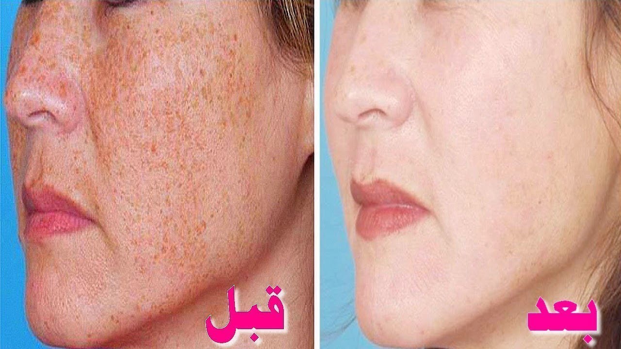وصفة طبيعية جبارة للتخلص من النمش والكلف والهالأت السوداء نهائيا 5 وصفة طبيعية جبارة للتخلص من النمش والكلف والهالأت السوداء نهائيا