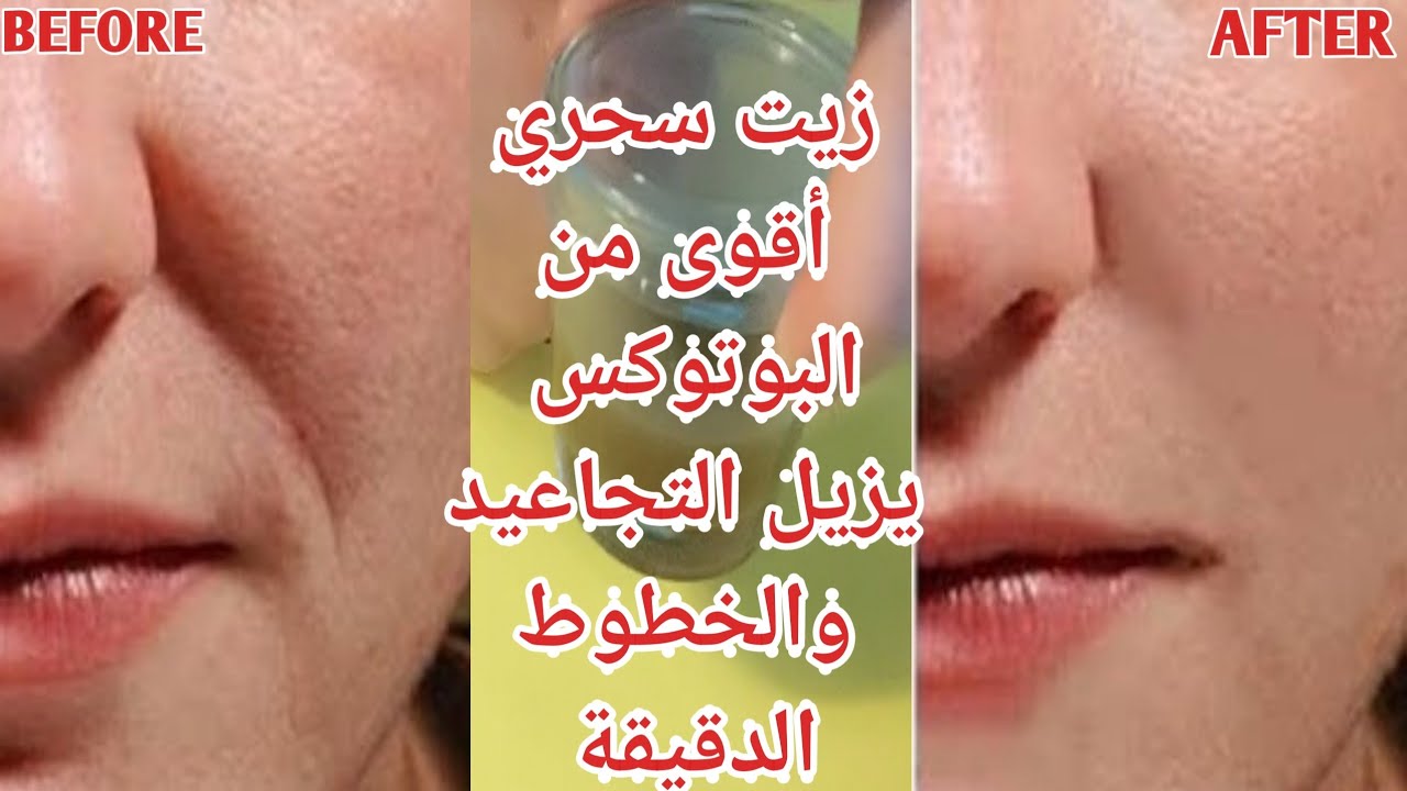 أقوى من البوتكس ... زيت سحري للتجاعيد هيخفيها من أول مرة وتحدي 5 أقوى من البوتكس … زيت سحري للتجاعيد هيخفيها من أول مرة وتحدي