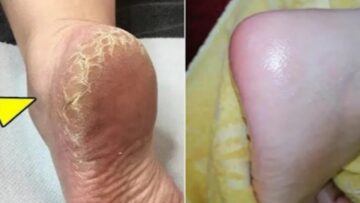 وصفات لعلاج جفاف الكعبين بمكونات طبيعية 100% من البيت
