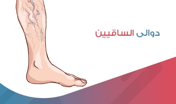 أسباب ظهور الدوالي وأفضل طرق للعلاج منها في وصفات طبيعية من المنزل وبدون تدخل جراحي
