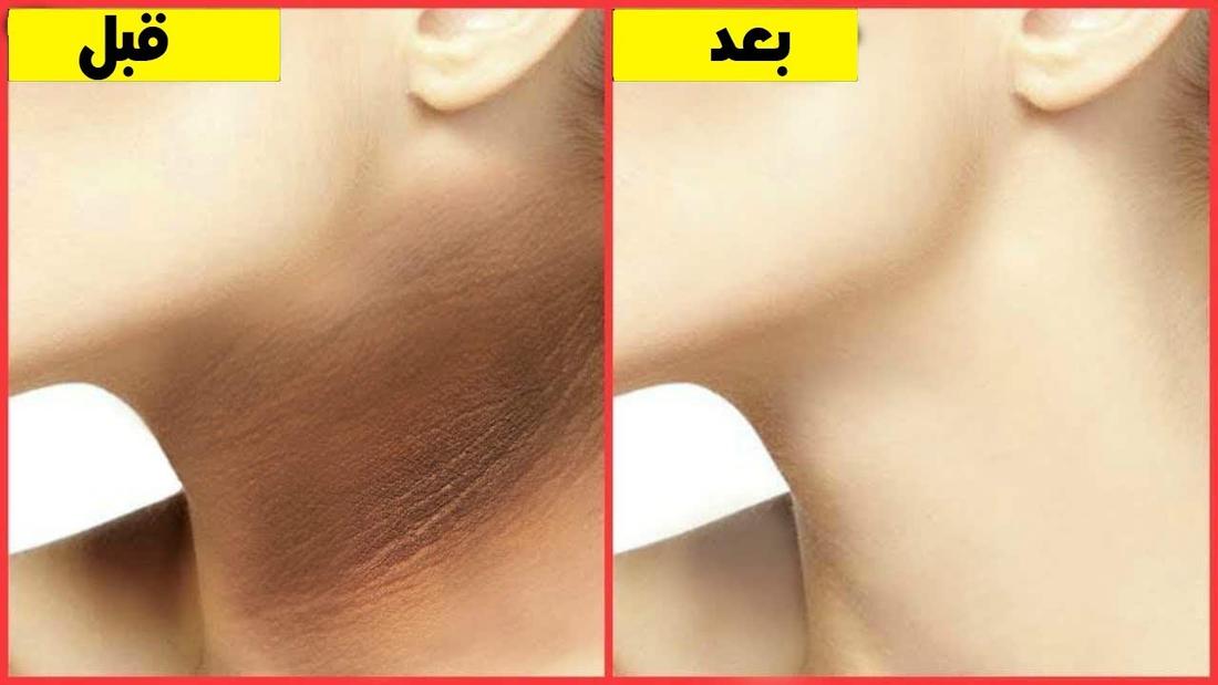 وصفة تبييض الرقبة في ربع ساعة فقط هتزيلي كل السواد والبقع الي في رقبتك