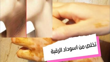 وصفة تفتيح الرقبة الداكنة بـ 4 طرق طبيعية لإزالة الجلد الميت والكلف
