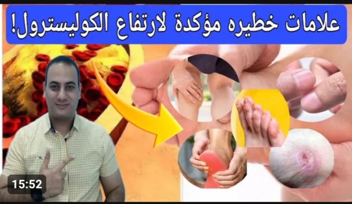 هتموت في لمح البصر .. اخطر طعام يتسبب في ارتفاع الكوليسترول .. خطير للغاية ابتعد عنه فوراً وخلي بالك 5 هتموت في لمح البصر .. اخطر طعام يتسبب في ارتفاع الكوليسترول .. خطير للغاية ابتعد عنه فوراً وخلي بالك