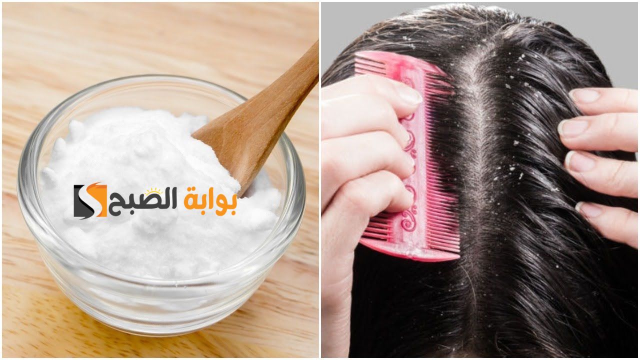 مستنية إيه طبقيها بسرعة.. مجموعة مختلفة من الوصفات للتخلص من قشرة الشعر وبشكل نهائي " مجربة وطبيعية " 5 مستنية إيه طبقيها بسرعة.. مجموعة مختلفة من الوصفات للتخلص من قشرة الشعر وبشكل نهائي ” مجربة وطبيعية “