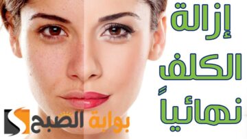 وداعا لمشكلة الكلف والنمش …. وصفات طبيعية لازالة النمش والكلف نهائيا