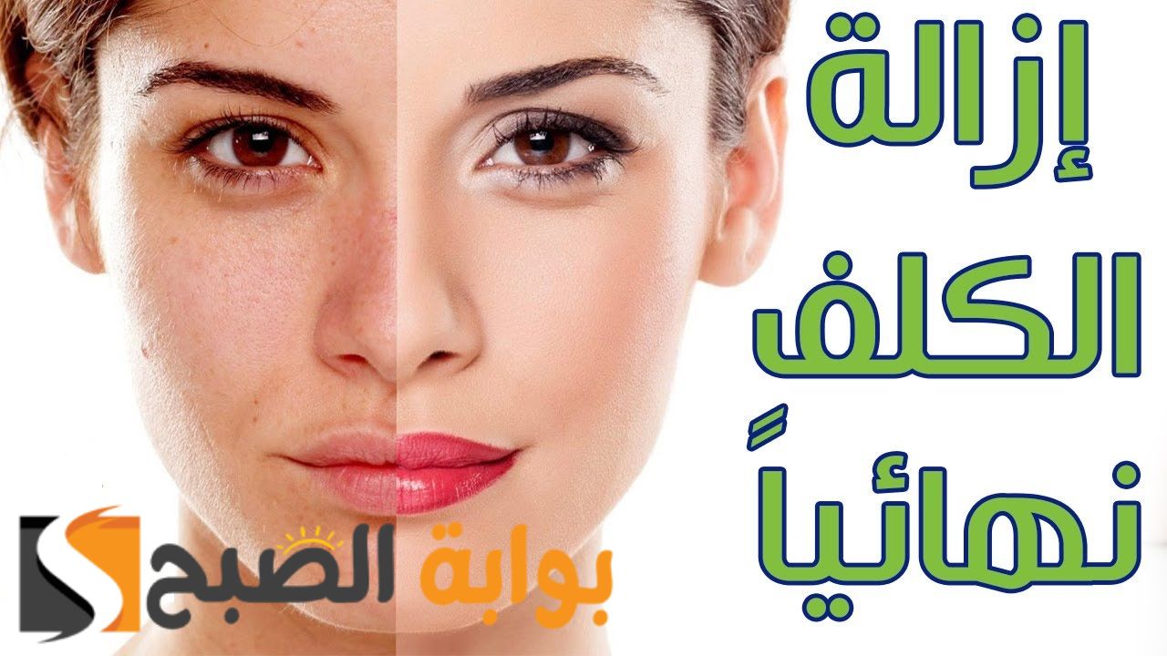 وداعا لمشكلة الكلف والنمش .... وصفات طبيعية لازالة النمش والكلف نهائيا 5 وداعا لمشكلة الكلف والنمش …. وصفات طبيعية لازالة النمش والكلف نهائيا