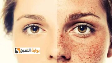 عشان وشك ينور.. تخلصي الآن من النمش نهائياً بمجموعة من الوصفات الطبيعية على قد الإيد “بشرتك هتبقى عاملة زي البلور”
