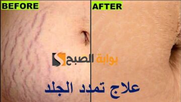 للجنس الناعم.. اعرفيها دلوقتي أسباب ظهور علامات تمدد الجلد ووسائل التخلص منها بطرق سريعة وغير مكلفة في البيت “هتشكريني عليها طول حياتك”