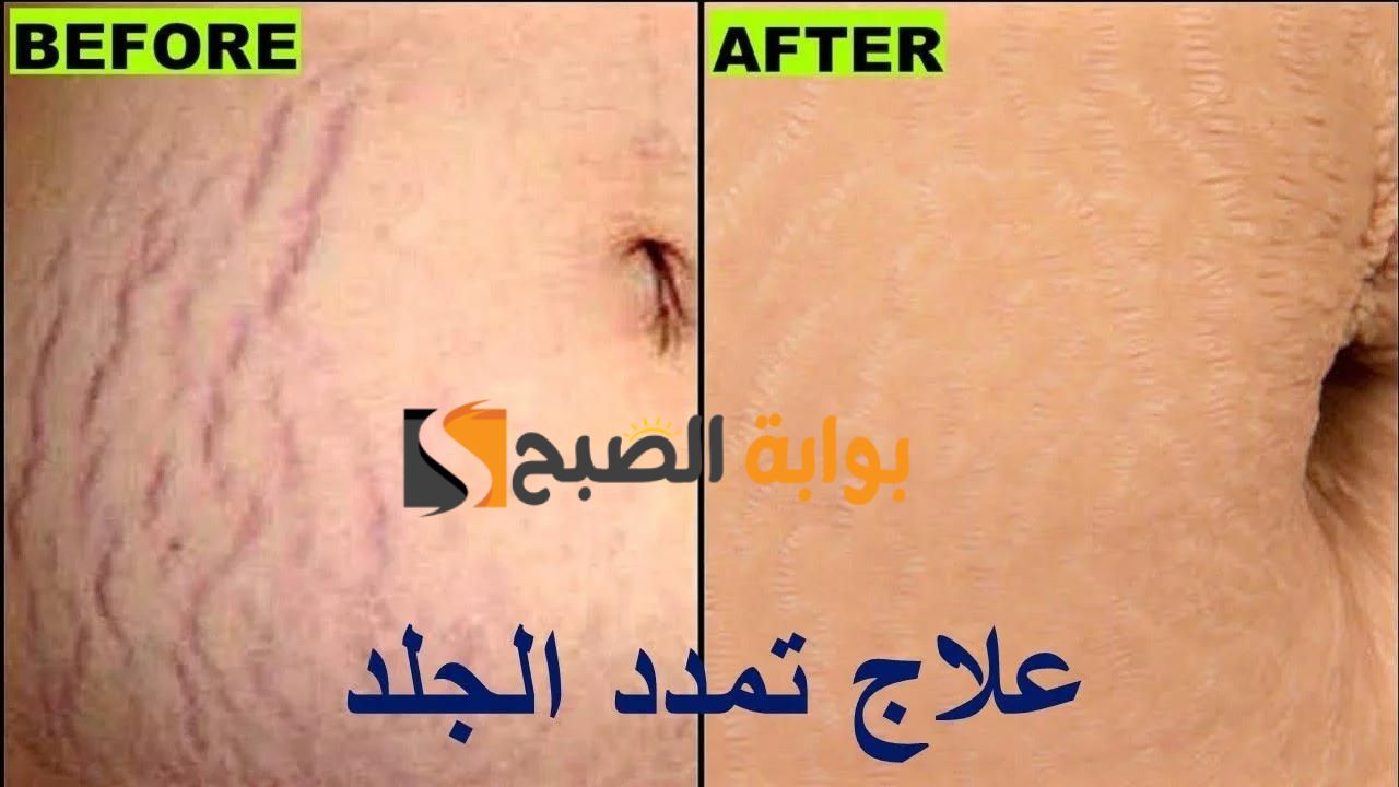 للجنس الناعم.. اعرفيها دلوقتي أسباب ظهور علامات تمدد الجلد ووسائل التخلص منها بطرق سريعة وغير مكلفة في البيت "هتشكريني عليها طول حياتك" 5 للجنس الناعم.. اعرفيها دلوقتي أسباب ظهور علامات تمدد الجلد ووسائل التخلص منها بطرق سريعة وغير مكلفة في البيت “هتشكريني عليها طول حياتك”