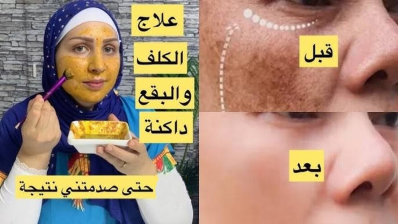 وفري فلوسك.. علاج طبيعي سحري هيخلصك من الكلف بسرعة رهيبة مش هتصدقيها