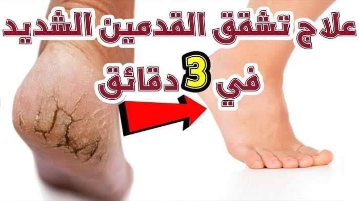 وفري فلوس الكوافير.. وصفات منزلية للتخلص من تشققات القدم لازم تجربيها 5 وفري فلوس الكوافير.. وصفات منزلية للتخلص من تشققات القدم لازم تجربيها