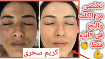 ماسك طبيعي لعلاج الكلف نهائيا خلال 3 أيام بأسهل طريقة