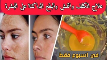 جبتلك الحل الجبار.. عشبة طبيعية لعلاج الكلف والنمش في خلال 3 أيام