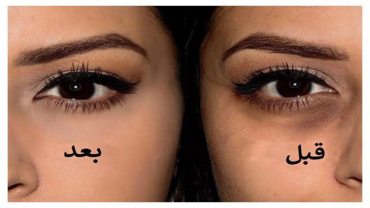 عيونك هترجع تنور.. اقوى حل طبيعي للهالات السوداء خلال اسبوع واحد فقط 5 عيونك هترجع تنور.. اقوى حل طبيعي للهالات السوداء خلال اسبوع واحد فقط