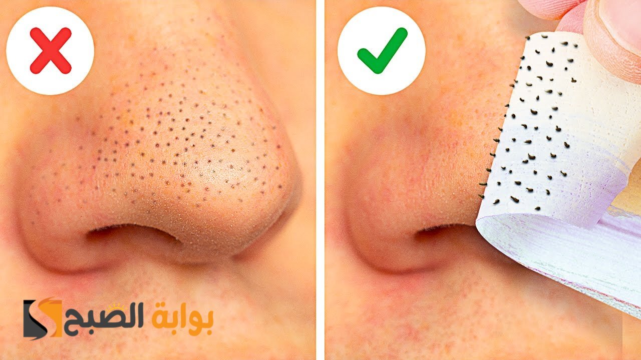  أفضل وصفات للتخلص من الرؤوس السوداء في المنزل
