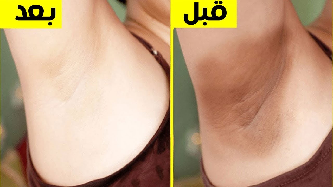مكون التفتيح الفوري لكل عروسة لتبييض تحت الإبطين وإزالة الاسمرار والبقع من أول يوم 5 مكون التفتيح الفوري لكل عروسة لتبييض تحت الإبطين وإزالة الاسمرار والبقع من أول يوم