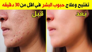 وصفة الخميرة والحليب لتبيض البشرة والجسم كله وإزالة البقع والتصبغات نهائيا