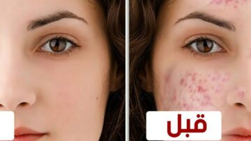 وصفة طبيعية لعلاج حب الشباب للبشرة الدهنية وتنظيف الوجه من الشوائب