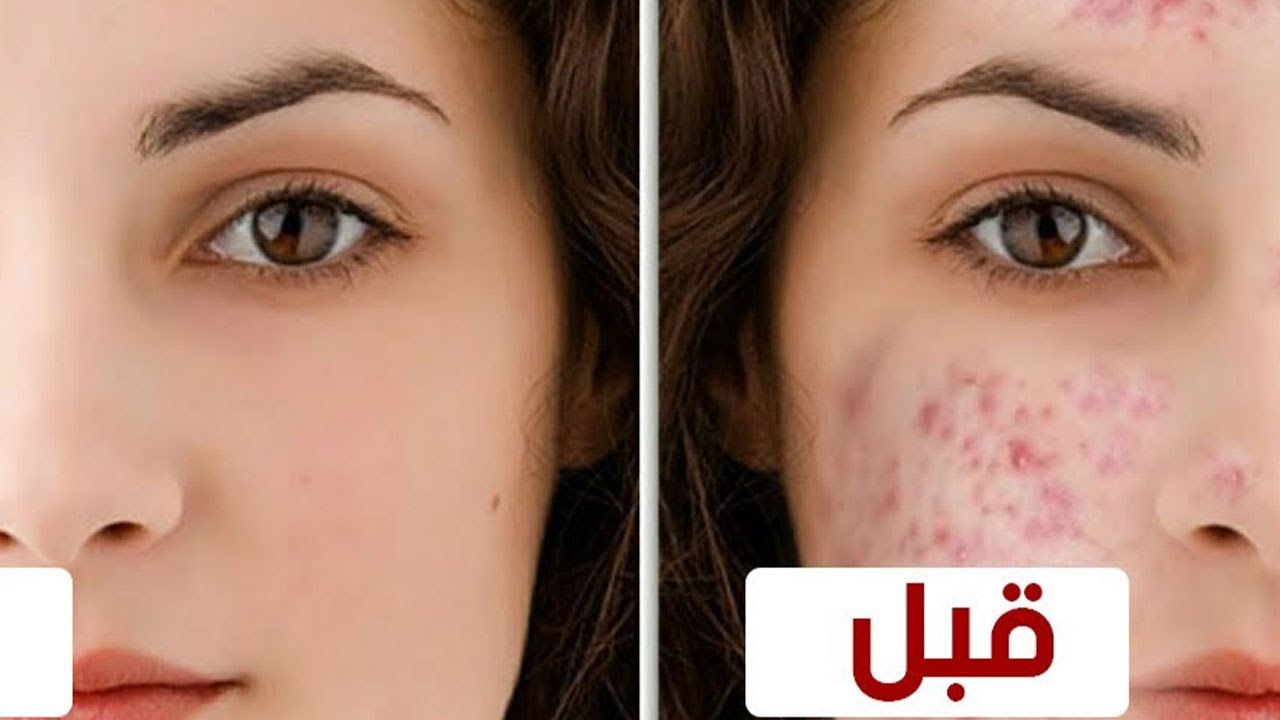 وصفة طبيعية لعلاج حب الشباب للبشرة الدهنية وتنظيف الوجه من الشوائب