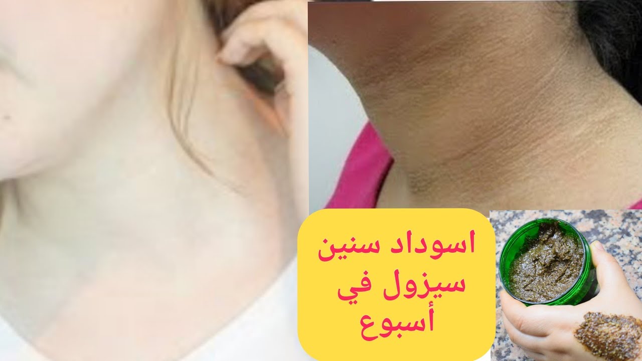بياض الثلج.. بملعقة فازلين تخلصي من سواد المناطق الحساسة والاسمرار حتي لو فحمة من أول يوم هتبقي زي القشطة 5 بياض الثلج.. بملعقة فازلين تخلصي من سواد المناطق الحساسة والاسمرار حتي لو فحمة من أول يوم هتبقي زي القشطة