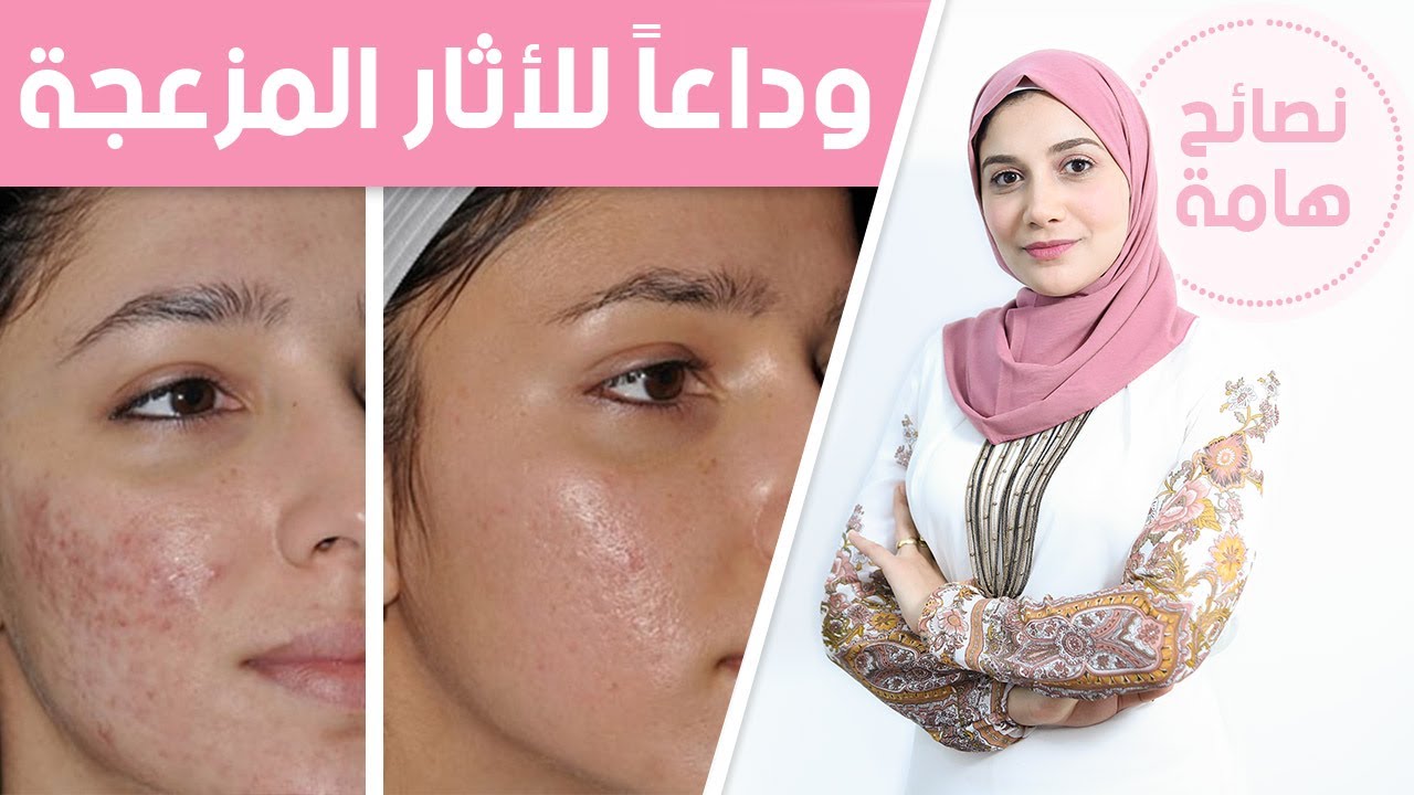 التخلص من آثار حب الشباب بكل سهولة وبطرق مجربة 5 التخلص من آثار حب الشباب بكل سهولة وبطرق مجربة