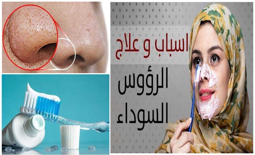 السر في معجون الأسنان للتخلص من الرؤوس السوداء.. وصفة جبارة 100% هتجيب من الاخر!