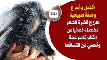 وصفة سحرية وفعالة للتخلص من القشرة بنتائج مذهلة بعد 3 أيام من الاستخدام!