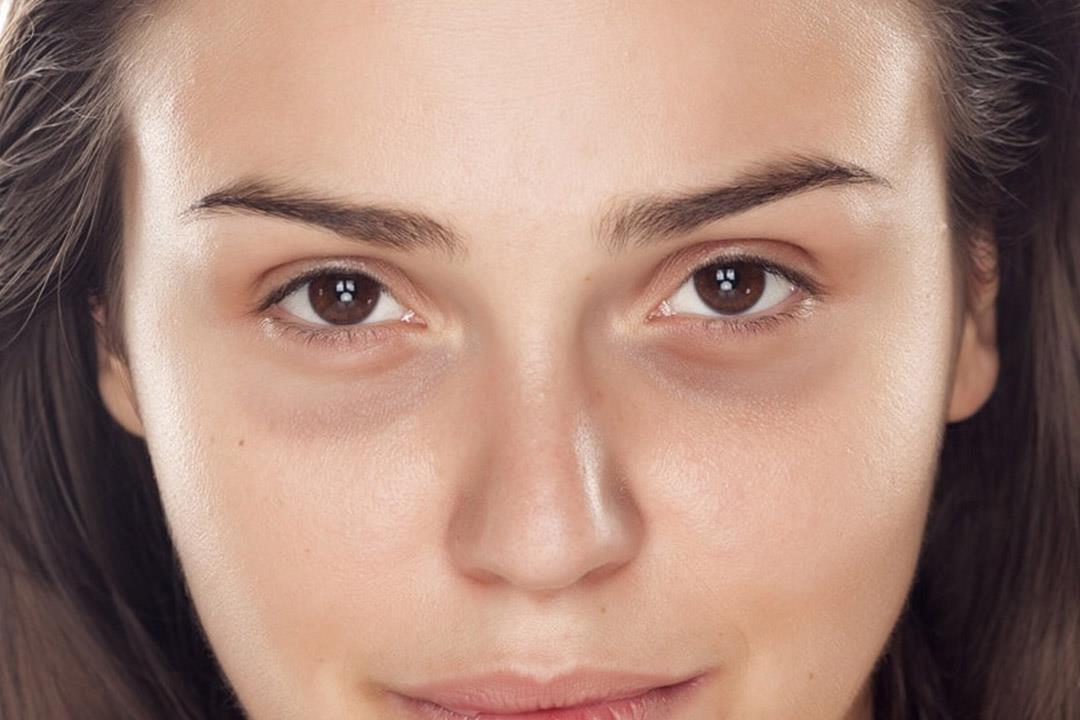 طريقة طبيعية للتخلص من الهالات السوداء تحت العين والحصول علي مظهر صحي