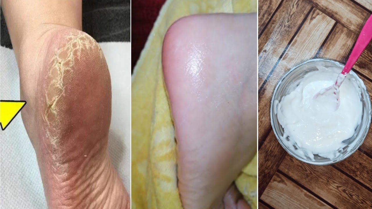 وداعآ لتشققات وخشونه القدمين بنص كوب خل وهتبقي نعمه زي رجل الأطفال