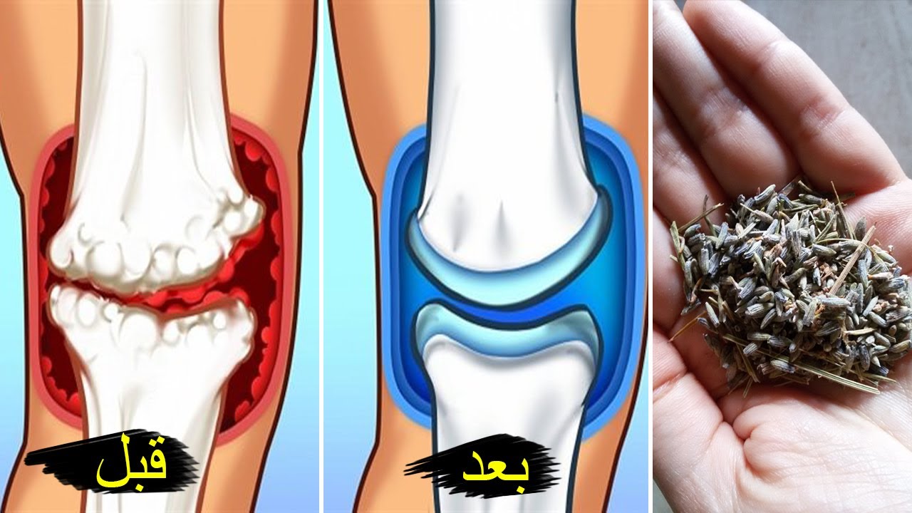 وصفات طبيعة تساعد في علاج مشكلة التهاب المفاصل.. تعرف عليها 5 وصفات طبيعة تساعد في علاج مشكلة التهاب المفاصل.. تعرف عليها