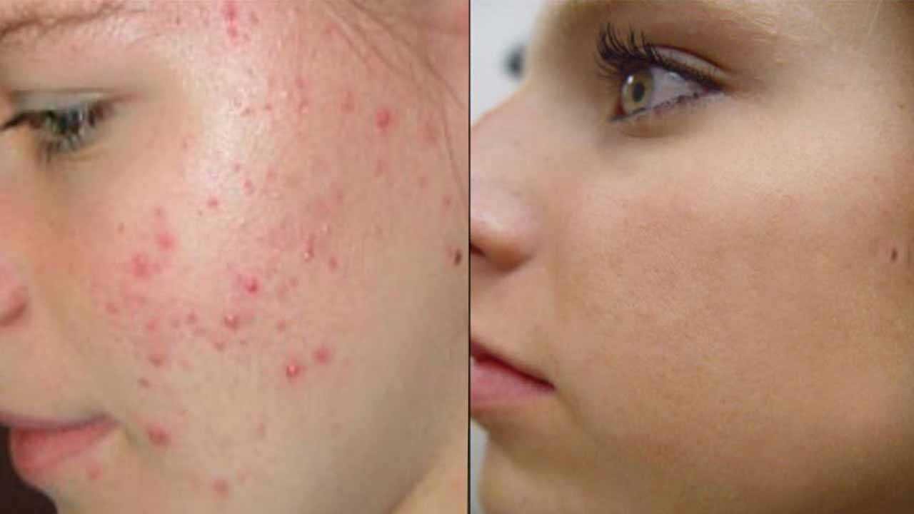 لبشرة صافية ونضرة..إليك أفضل الوصفات الطبيعية للتخلص من آثار الحبوب في الوجه 5 لبشرة صافية ونضرة..إليك أفضل الوصفات الطبيعية للتخلص من آثار الحبوب في الوجه