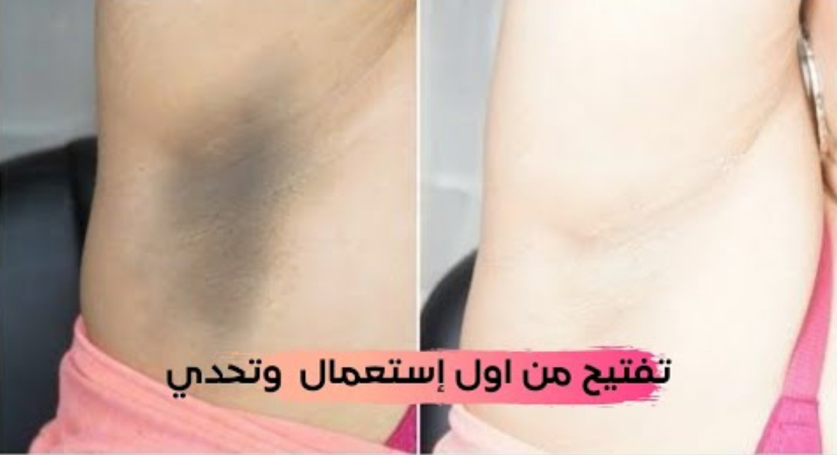 بياض الثلج.. وصفة صاروخية لتبييض الابطين والمناطق الحساسة وإزالة سواد 20 سنة هتبقي زي القشطة 5 بياض الثلج.. وصفة صاروخية لتبييض الابطين والمناطق الحساسة وإزالة سواد 20 سنة هتبقي زي القشطة