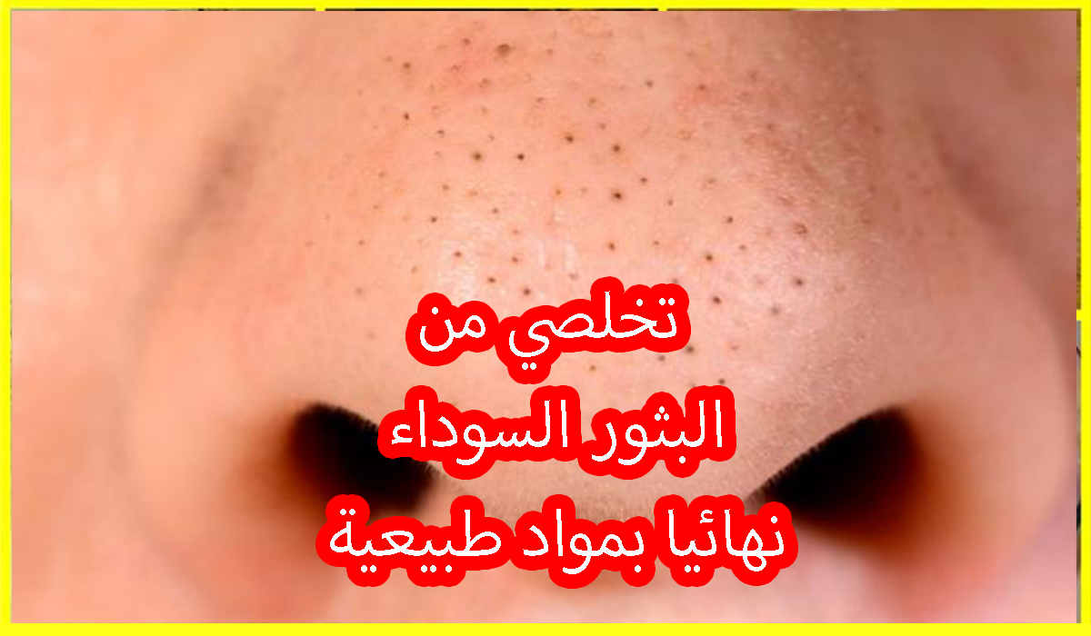 تخلصي من البثور السوداء في بشرتك بأسهل ماسك طبيعي