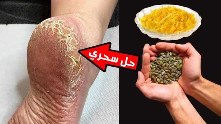هتبقى أنعم من الحرير.. تخلصى من تشققات الكعبين بكل سهولة بهذا المكون السحري.. هتخافي تمشي على الأرض بعدها! 5 هتبقى أنعم من الحرير.. تخلصى من تشققات الكعبين بكل سهولة بهذا المكون السحري.. هتخافي تمشي على الأرض بعدها!