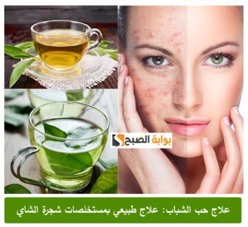 جربي وأحكمي بنفسك .. استخدمي الشاي الأخضر للتخلص من حب الشباب تماماً بدون رجعة ” بشرتك هتنبقى سيراميك”