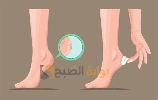 طريقة التخلص من تشققات القدمين والعناية بهم 5 طريقة التخلص من تشققات القدمين والعناية بهم